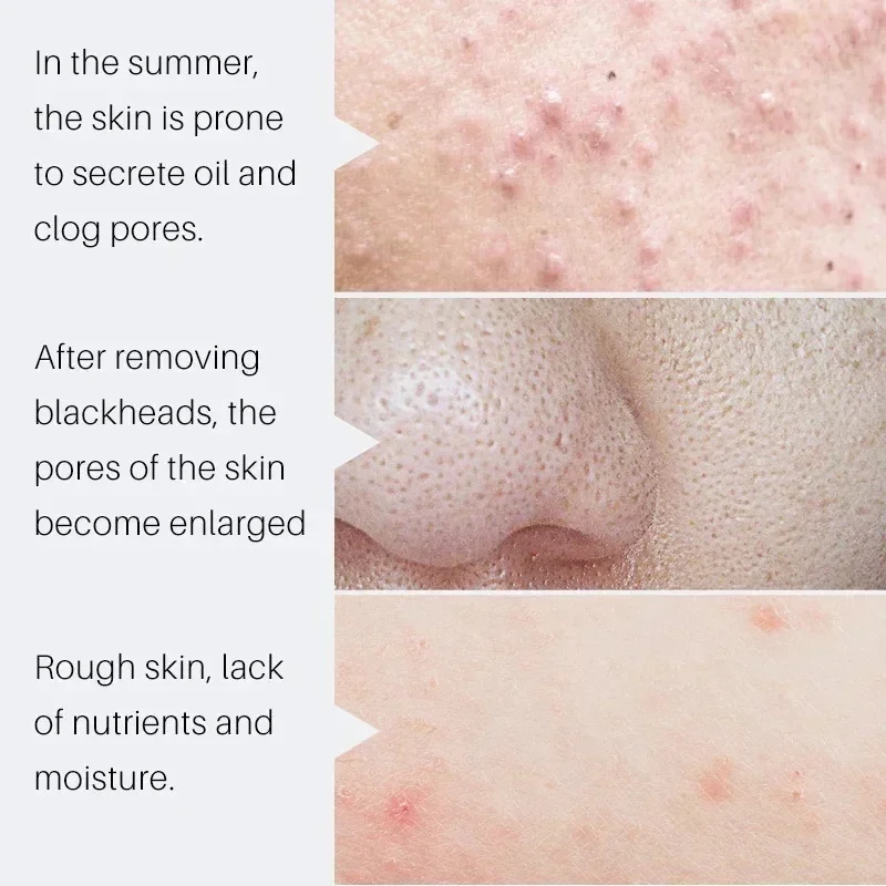 Sérum Réducteur de Pores à l'A - Salicylic Acid Blackhead Remover avis et prix